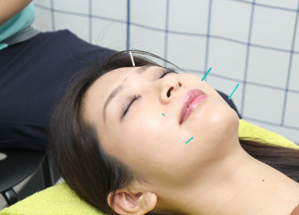 あかつき鍼灸整骨院の美容鍼の施術風景画像