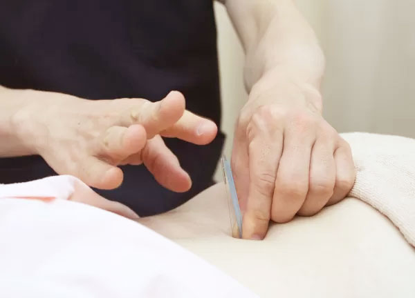 やすらぎ接骨院の鍼の施術風景画像01(埼玉県の鍼灸院コラムのおすすめ画像)
