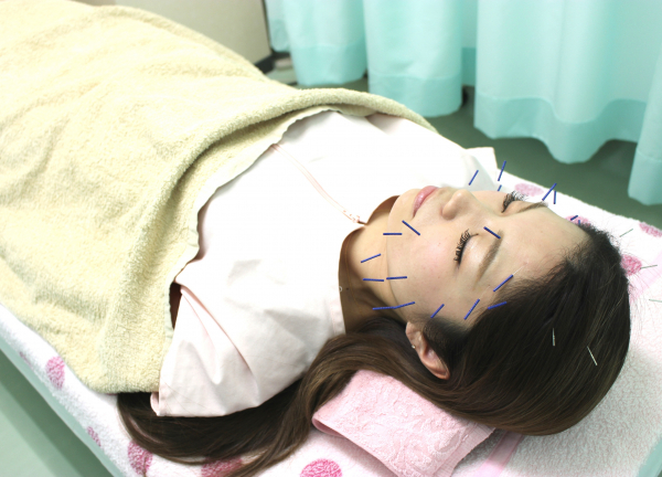 イスクラ鍼灸指圧接骨院の美容鍼の施術風景画像