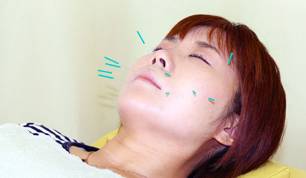 みずほ台ワイズ鍼灸接骨院の施術風景画像(富士見市の美容鍼コラムのおすすめ画像)